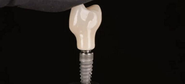 Implant dentaire surmonté d'une couronne, sur fond noir