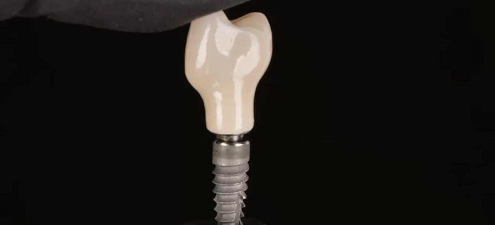 Implant dentaire surmonté d'une couronne, sur fond noir