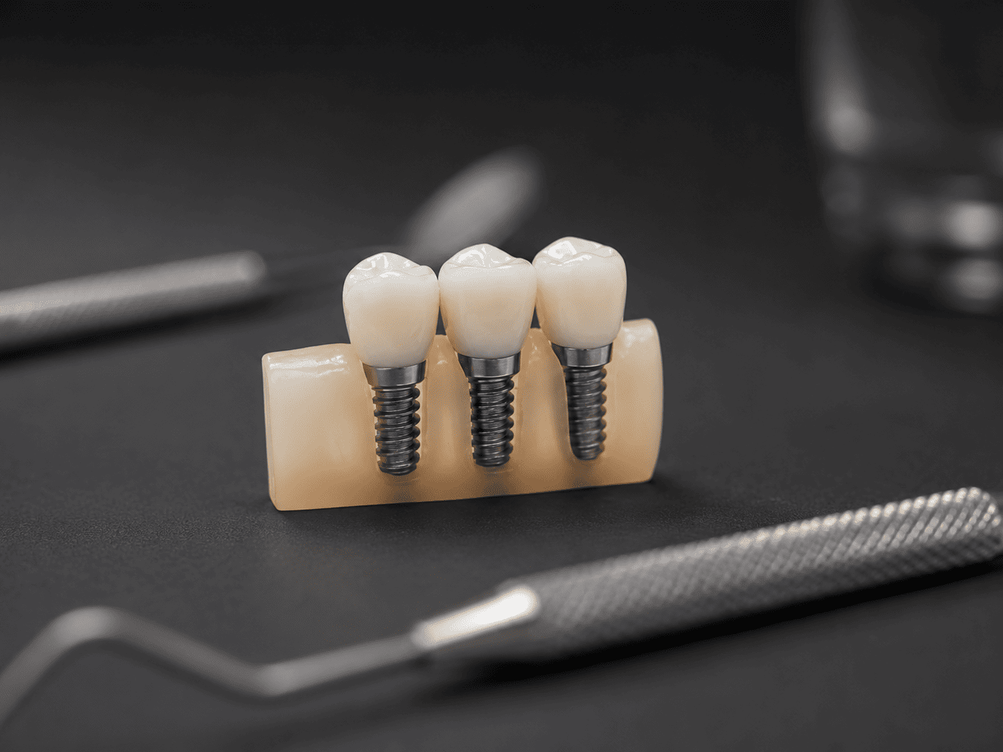 Maquette d'un bridge posé sur trois implants dentaires